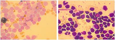 Case Report: A case of infantile acute hyperleukocytic leukemia treated by leukapheresis